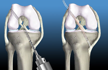 acl reconstruction